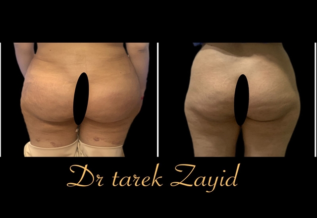 ترهلات الظهر